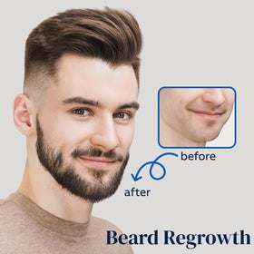 FUZYAT Minoxidil 5% Hair Growth Spray 180ml side view