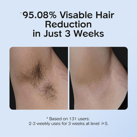 Generic IPL Hair Removal Device in use on leg