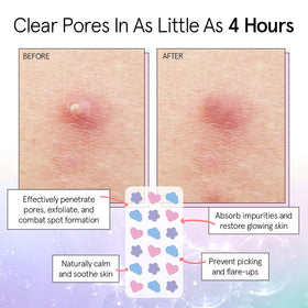 grace & stella hydrocolloid acne patches in blue cloud shape