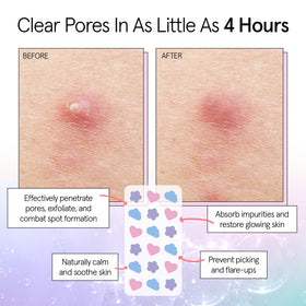 grace & stella Pimple Patches application on skin