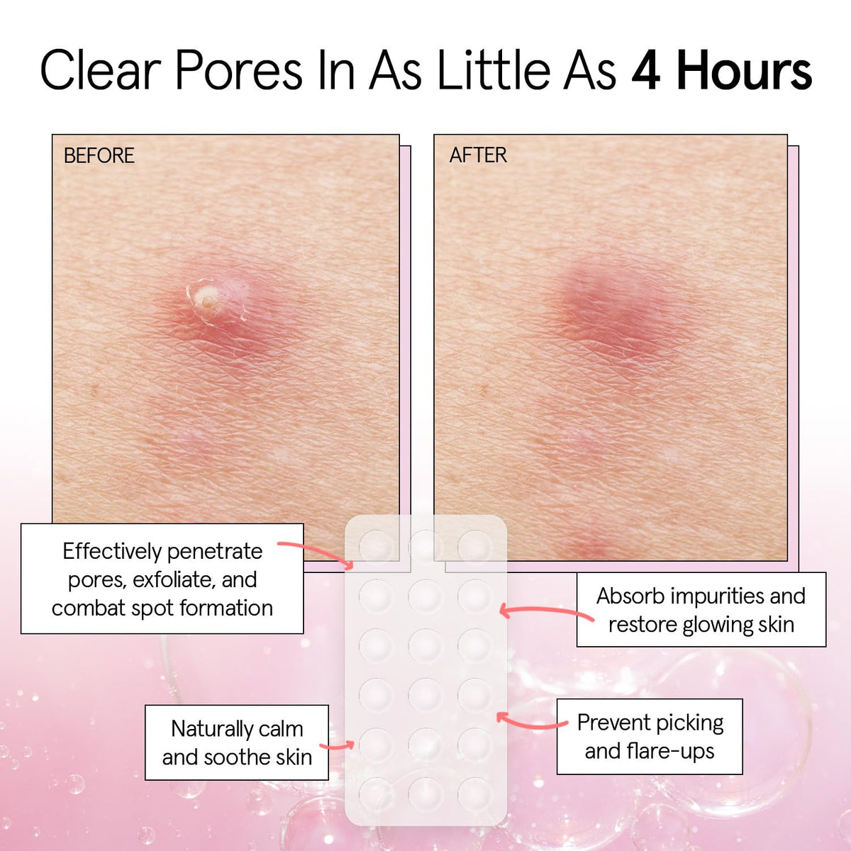 grace & stella Pore Strip Pimple Patches in use on skin