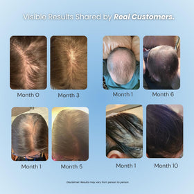 GROWPLEX Vitafoam 5% Minoxidil Foam application on scalp