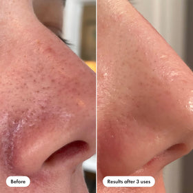 HERO COSMETICS Pore Release Blackhead Clearing Solution application on skin