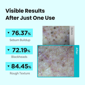 ILSO Deep Clean Master Tool in use on skin