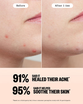 Ingredients list of PEACE OUT Acne Healing Dots