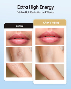 INNZA IPL Hair Removal Device in use on skin