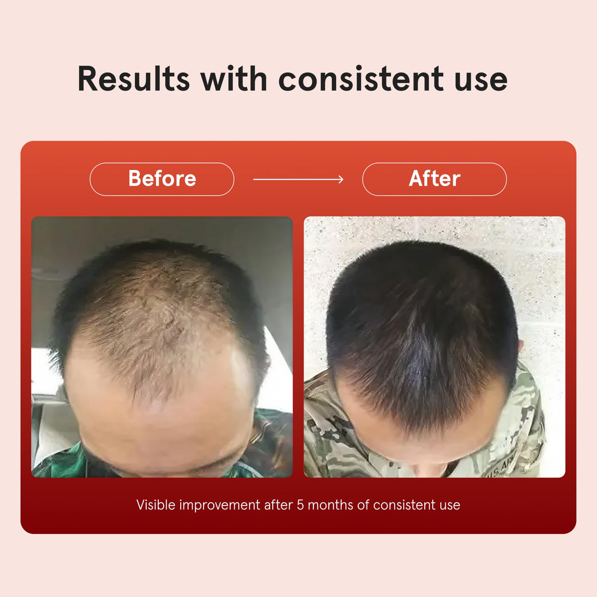 Keeps Minoxidil Solution dropper with liquid close-up