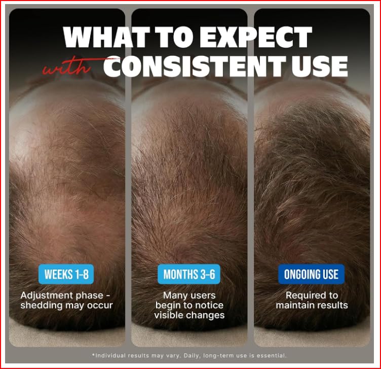 Kirkland Minoxidil 5% bottle with unscented drops
