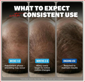 Kirkland Minoxidil 5% bottle with unscented drops