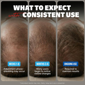 KIRKLAND Minoxidil 5% Hair Regrowth bottle close-up