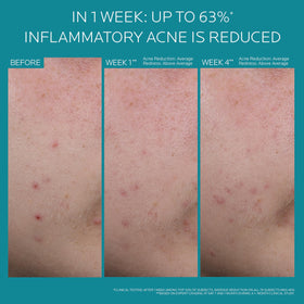 La Roche-Posay Effaclar BPO Multi-Target Acne ingredients list