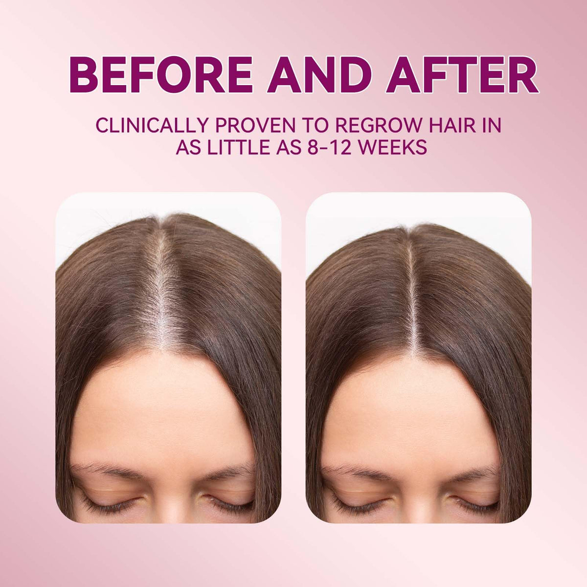 Lavtek 5% Minoxidil serum application on scalp