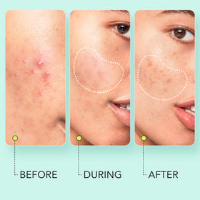 LitBear Large Pimple Patches 14mm size close-up