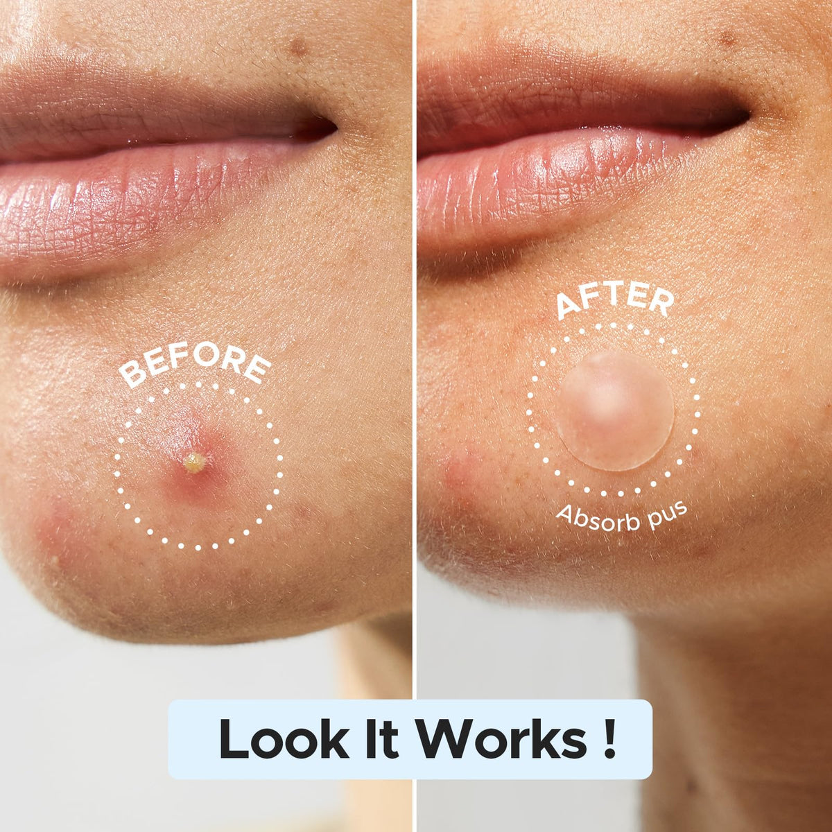 LitBear Pimple Patch showing 12mm size