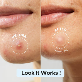 LitBear Pimple Patch showing 12mm size