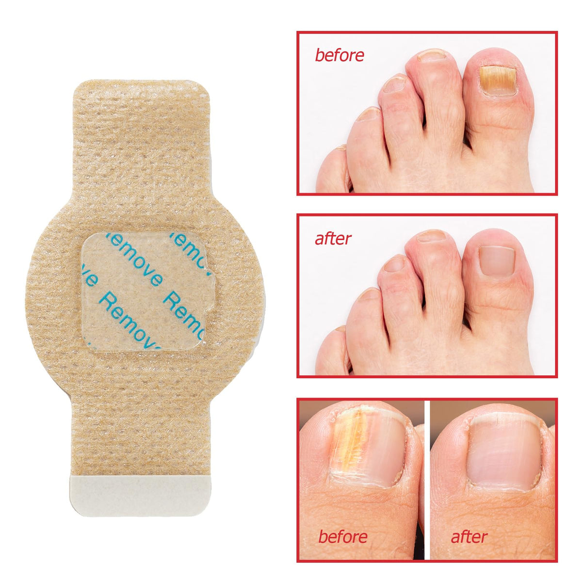 LTQXGT Toenail Care Patches showing self-adhesive design