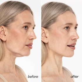 MAREE V Line Lifting Mask applied on a model's face