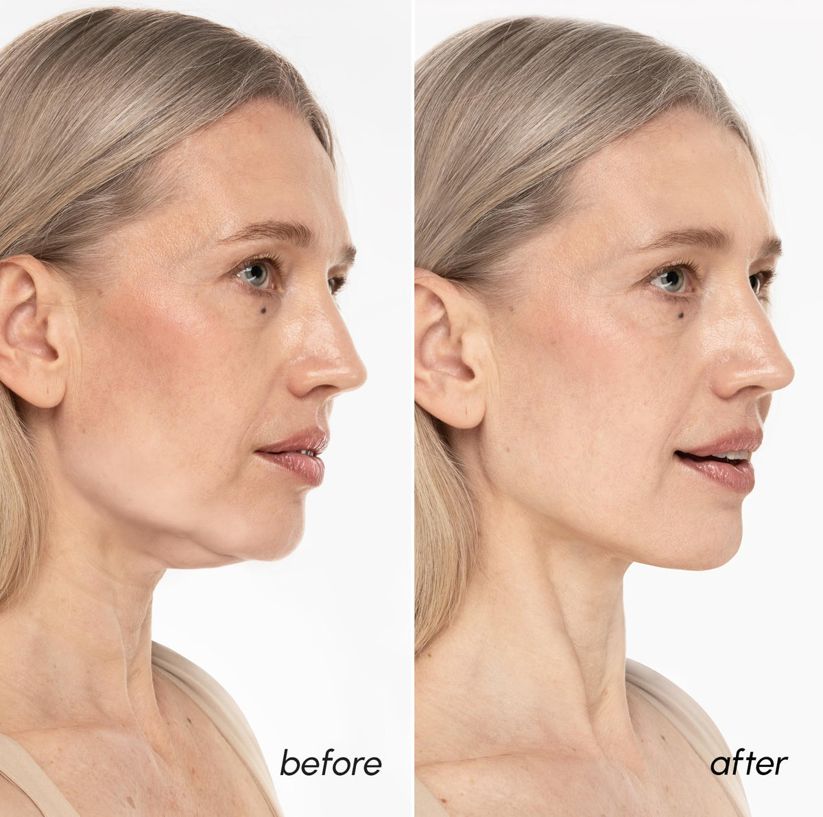 MAREE V Line Lifting Mask showing neck coverage