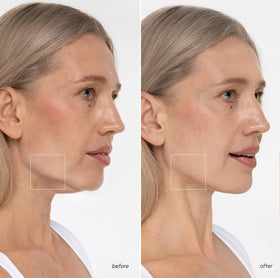 MAREE V Line Lifting Mask side view with neck coverage