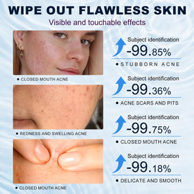 Marianp Azelaic Acid 10% Cream in lifestyle setting