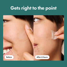Mighty Patch Micropoint XL Acne Pimple Patches easy-peel sheet