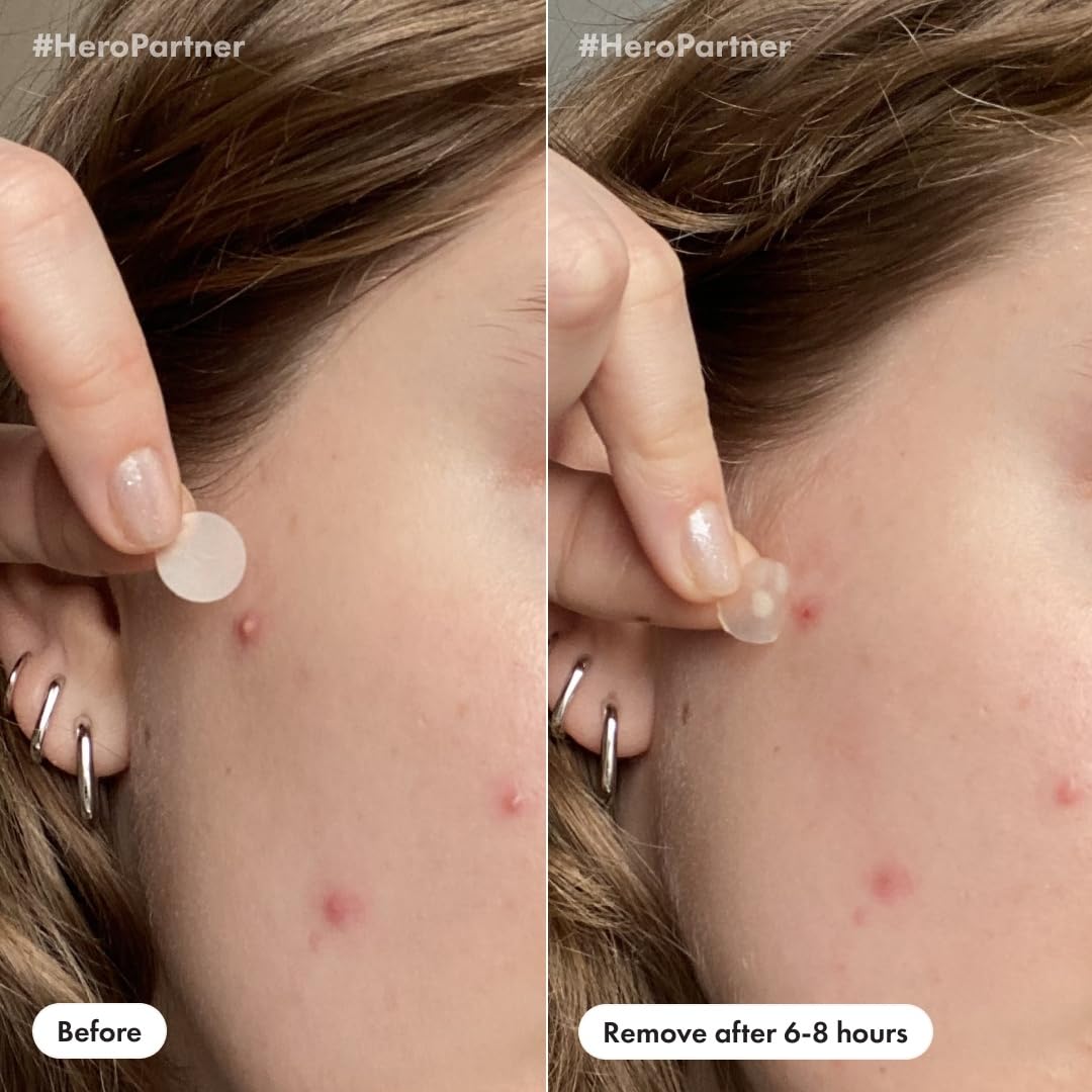 Mighty Patch patches in use on skin
