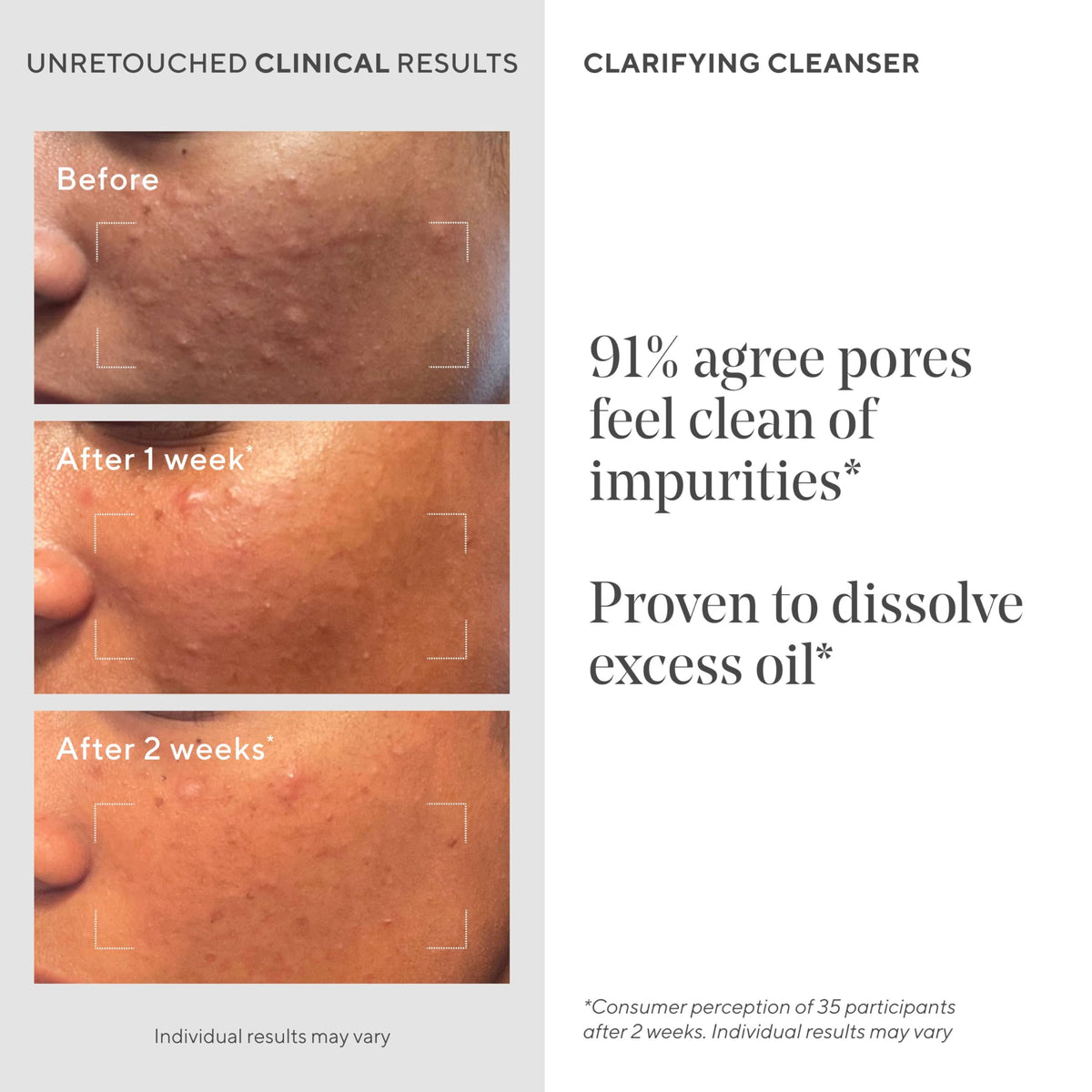Murad Acne Control Clarifying Cleanser application on hand