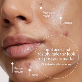 Neutrogena Evenly Clear Acne Cleanser with product label