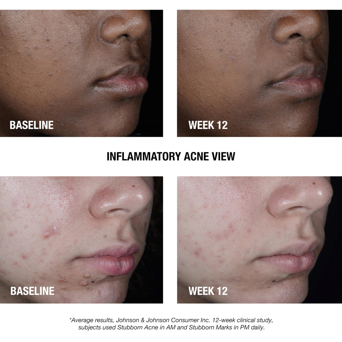 Neutrogena Stubborn Acne AM packaging details