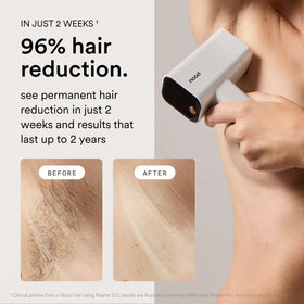 Nood Flasher Pro IPL device side view showing controls