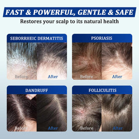 oely Anti-Dandruff Shampoo application on hair