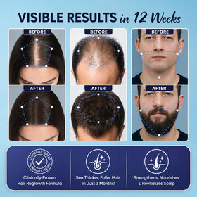 OLIVITA Hair Growth Serum 5% Minoxidil application on hair