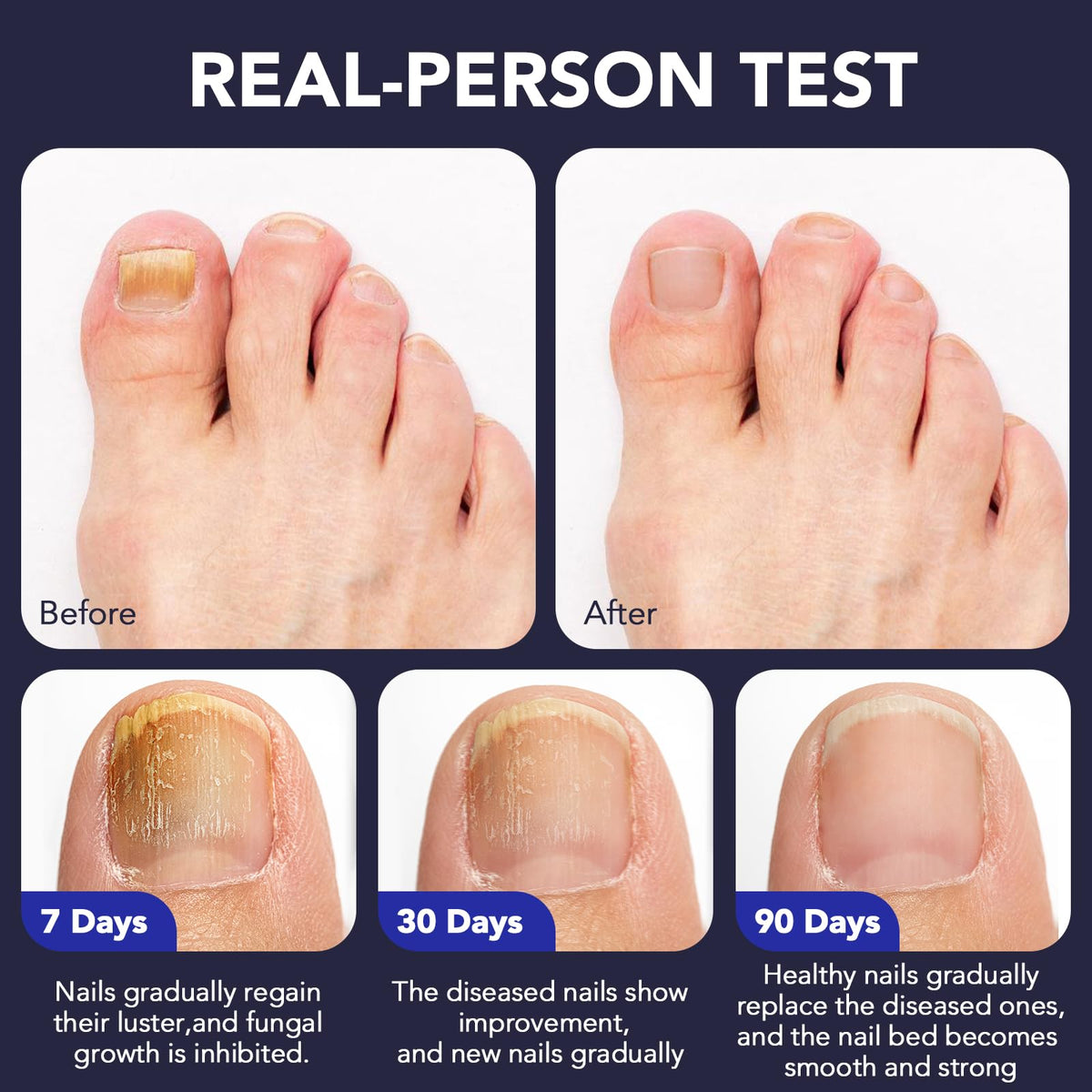 OMZOK Toenail Fungus Pen with soothing oils