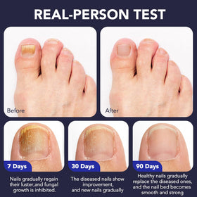 OMZOK Toenail Fungus Pen with soothing oils
