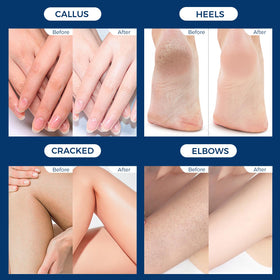 OUKEYA Urea Foot Cream 12.35 oz with other foot care products