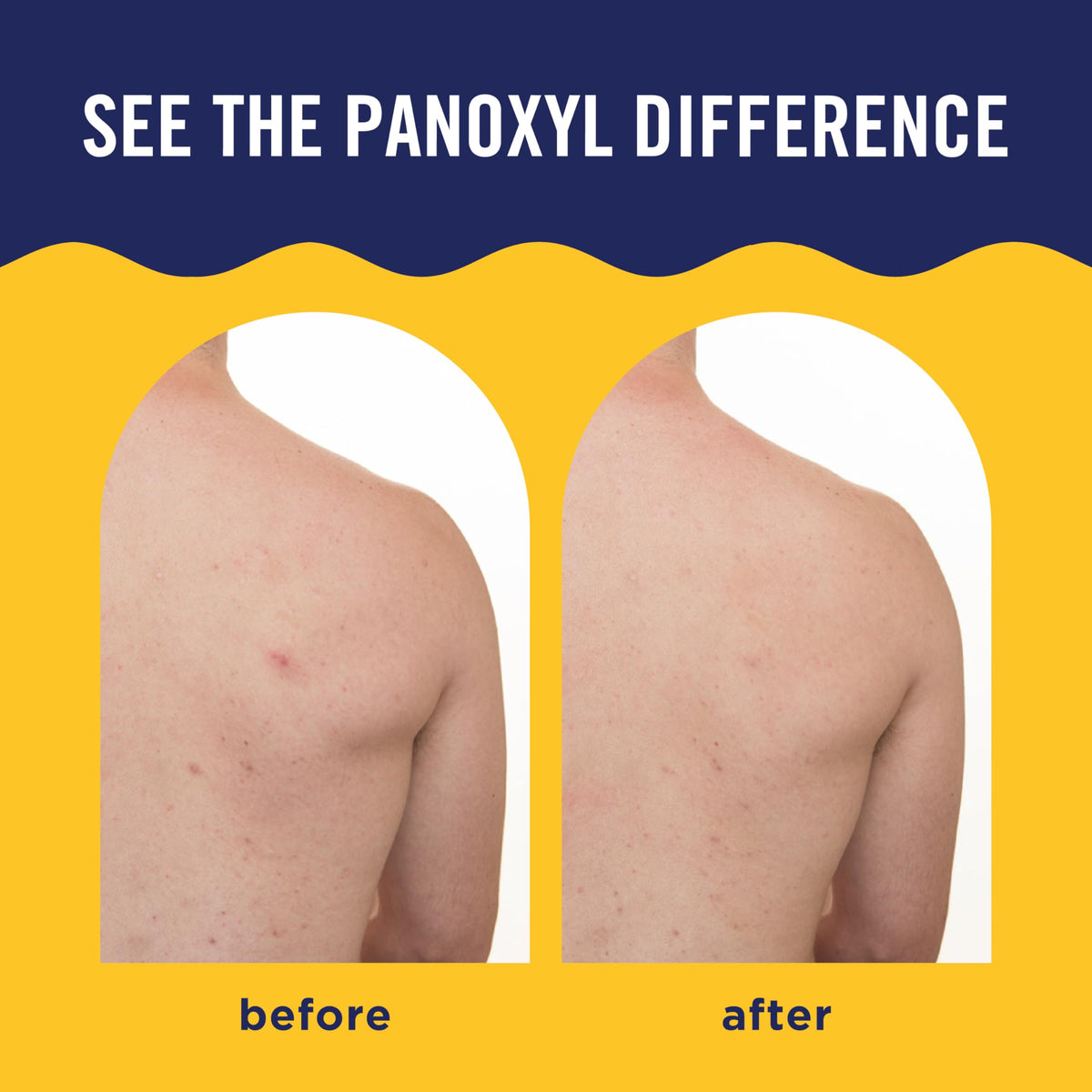 PanOxyl Acne Banishing Body Spray in a bathroom setting