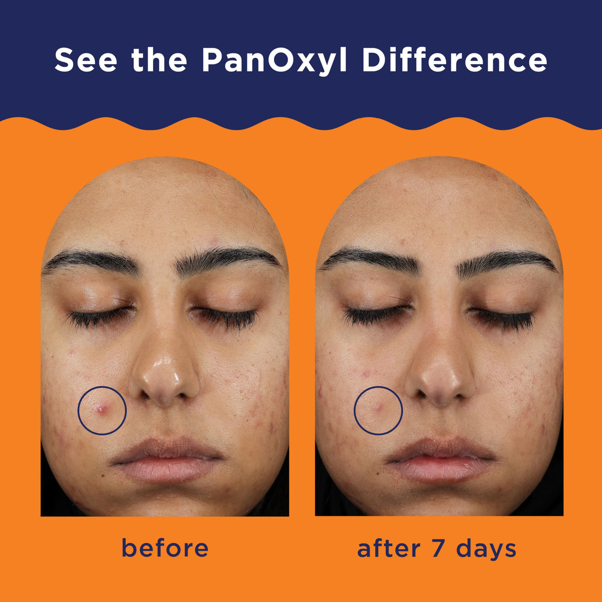 PanOxyl Acne Clearing Spot texture on hand