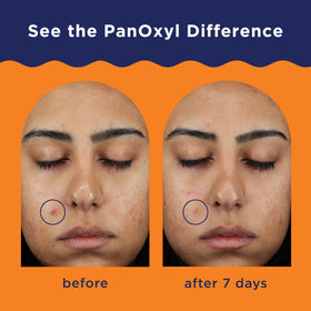 PanOxyl Acne Clearing Spot texture on hand