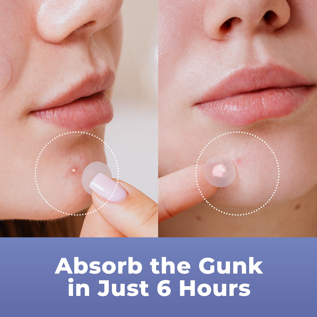 PatchRx Pimple Patches with tea tree oil and salicylic acid