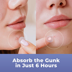 PatchRx Pimple Patches with tea tree oil and salicylic acid