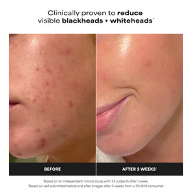 Paula's Choice 2% BHA Liquid Exfoliant bottle with cap