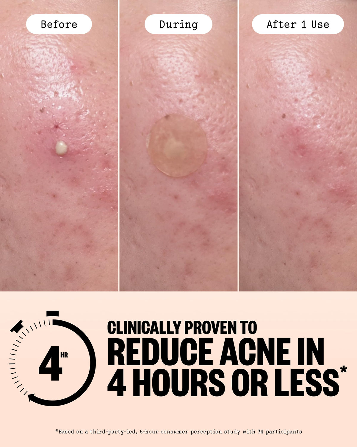 PEACE OUT Acne Healing Dots applied on blemish
