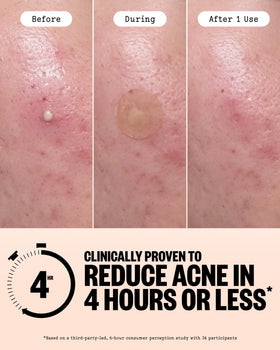 PEACE OUT Acne Healing Dots applied on blemish