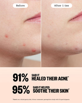 PEACE OUT Acne Healing Dots showing texture