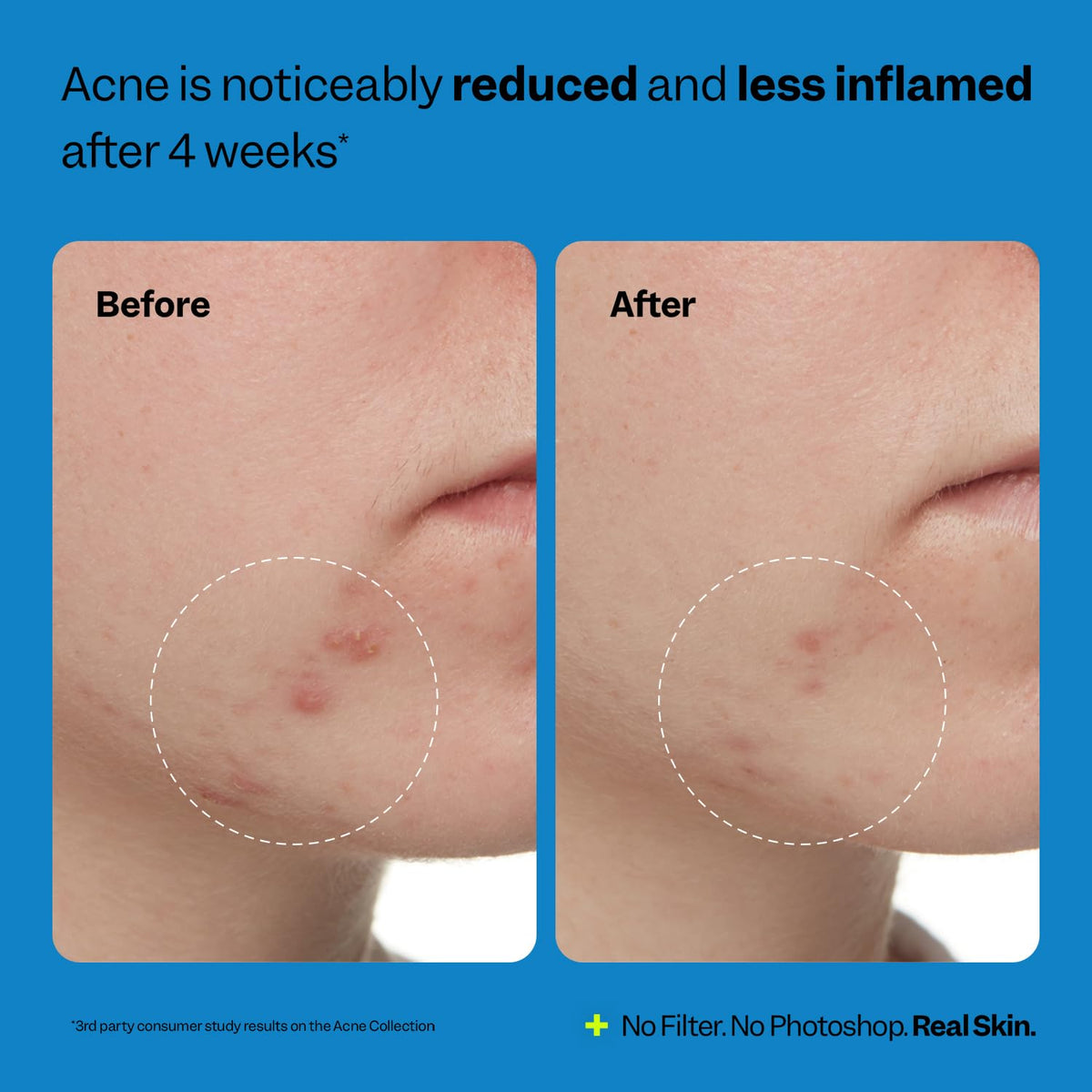 Peach Slices Acne Exfoliating Toner 4.05 oz packaging