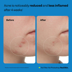 Peach Slices Acne Exfoliating Toner 4.05 oz packaging