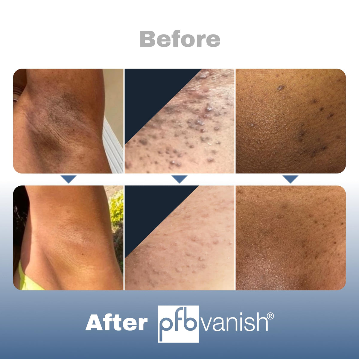 PFB Vanish Ingrown Hair 3.28 oz side view