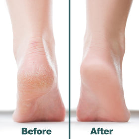 Probelle Double Sided Nickel Foot File in use on cracked heels