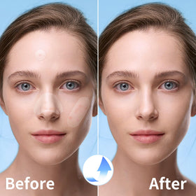 QUSTERE pimple patches applied on skin showing effectiveness