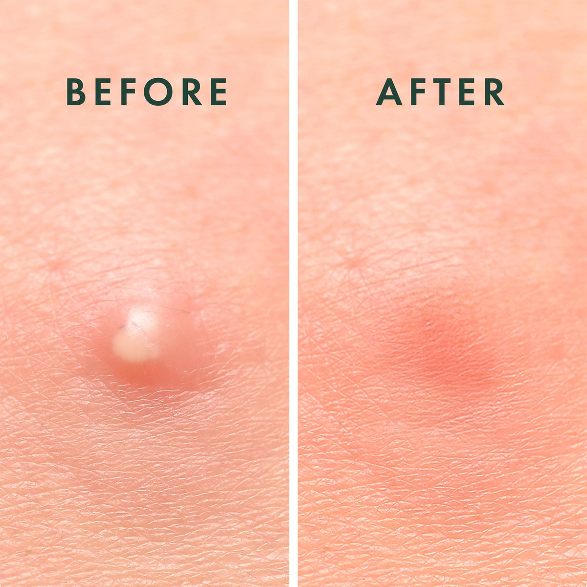 Rael Acne Pimple Patches applied on skin for blemish coverage